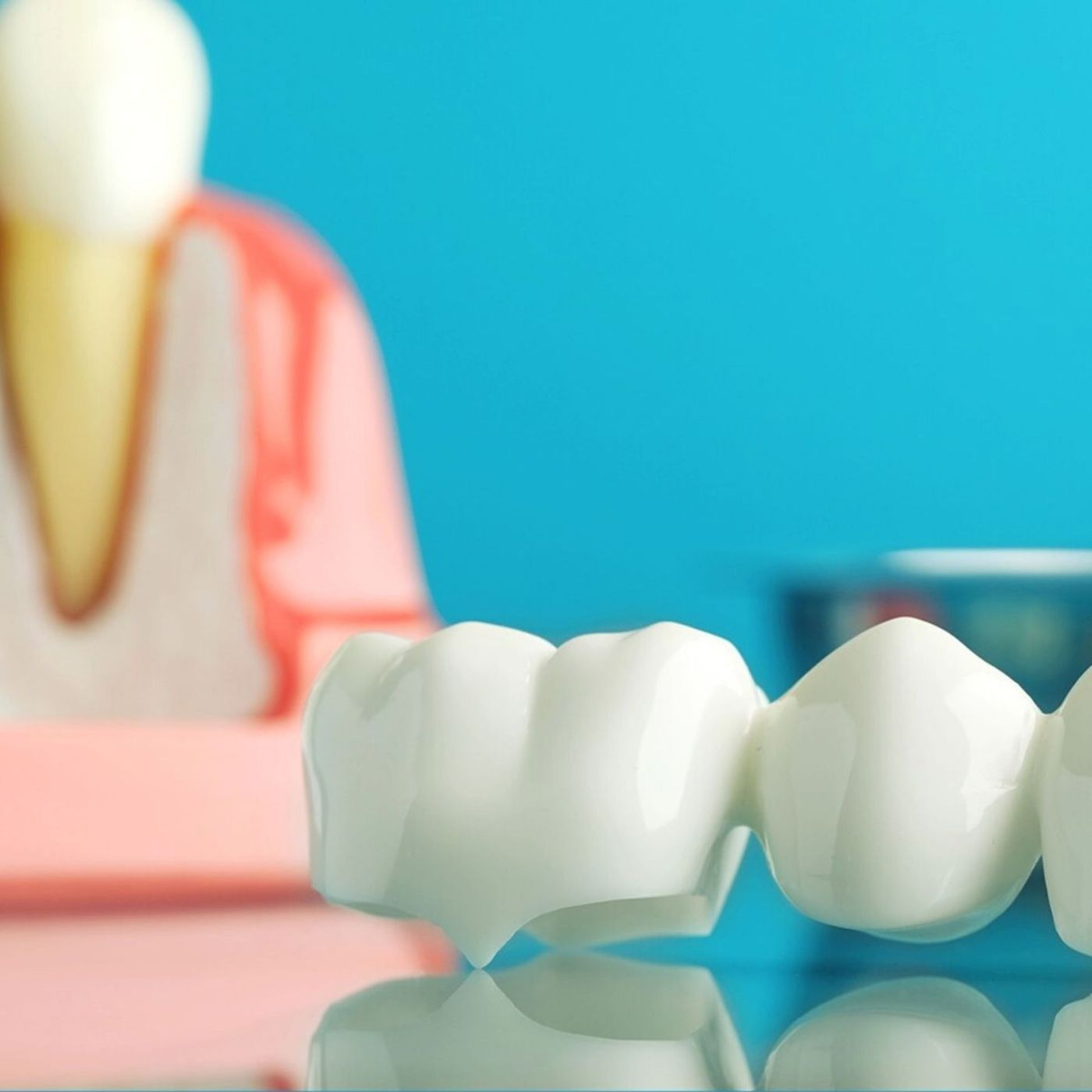 Implants & Restorations at De Santi Dental