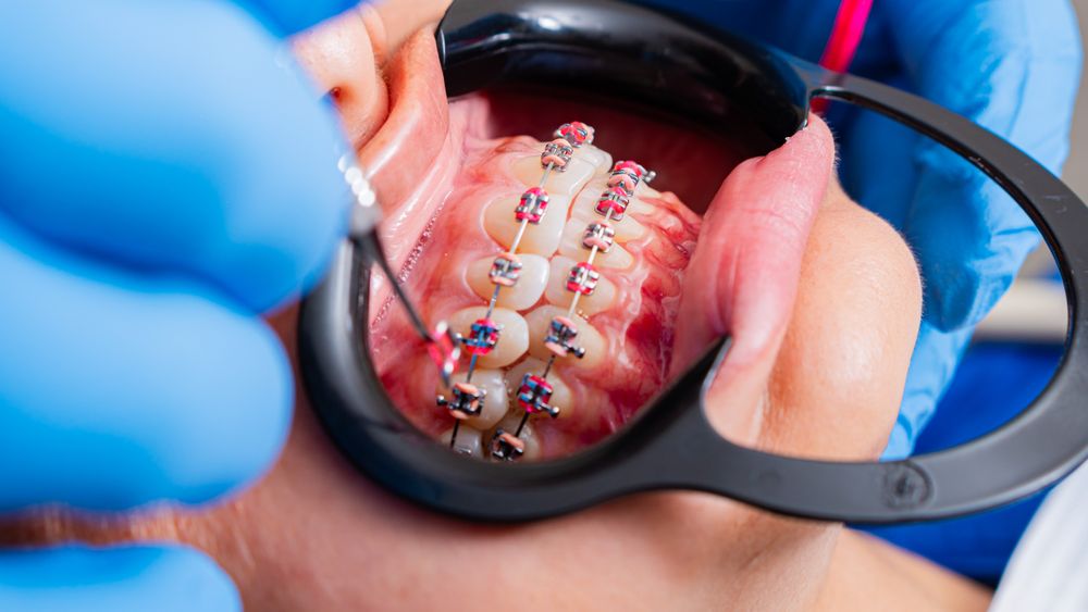 Close-up of braces on teeth
